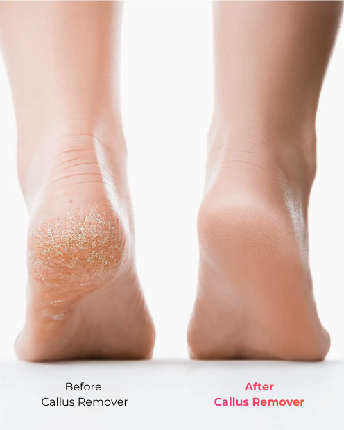 Foot Callus Remover Household Removable